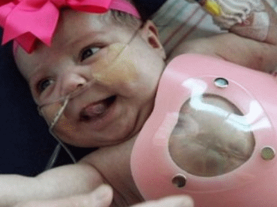 Una niña nació con el corazón fuera de su pecho. Fotos