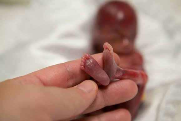 Fotos: Nació con 19 semanas y logró sobrevivir unos minutos