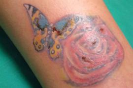 Los riesgos de tatuarse