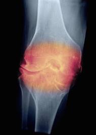 NUEVO TRATAMIENTO CON CELULAS MADRE PARA LA ARTROSIS