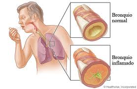 COMO PREVENIRSE DE LA BRONQUITIS
