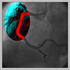 QUE ES Y EN QUE CONSISTE UN CATETERISMO?