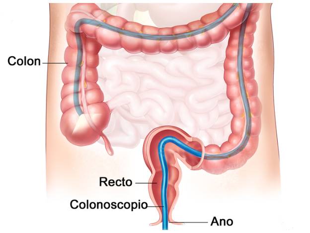 COLONOSCOPIA - A PARTIR DE LOS 50 A�OS SE RECOMIENDA HACERLA