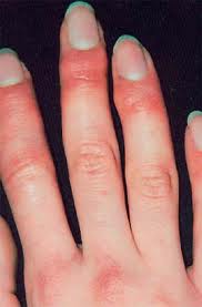 COMO COMBATIR Y ELIMINAR LOS SABA�ONES