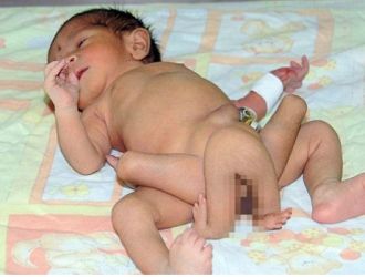 NACE UN BEBE CON 6 PIERNAS