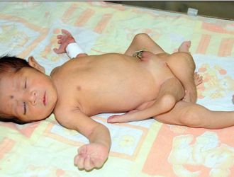 NACE UN BEBE CON 6 PIERNAS