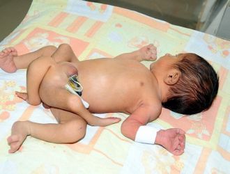 NACE UN BEBE CON 6 PIERNAS