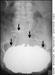Una radiograf�a muestra el est�mago del paciente lleno de monedas, collares y agujas.