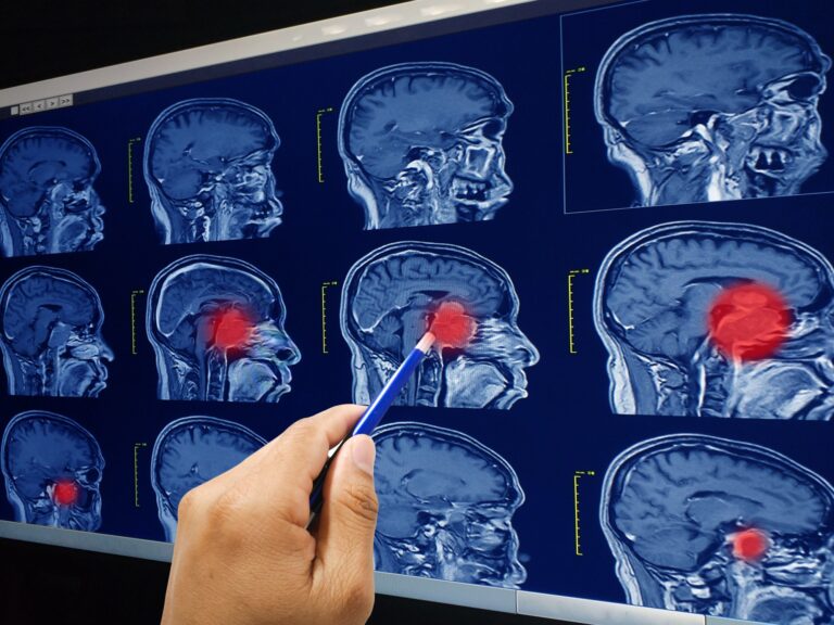 Descubren sorprendente causa cerebral que explica la resistencia del cáncer a la quimioterapia