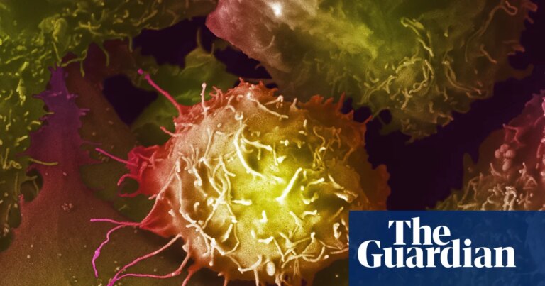 Expertos: La prueba de cáncer de próstata no debe ser de acceso general en el Reino Unido