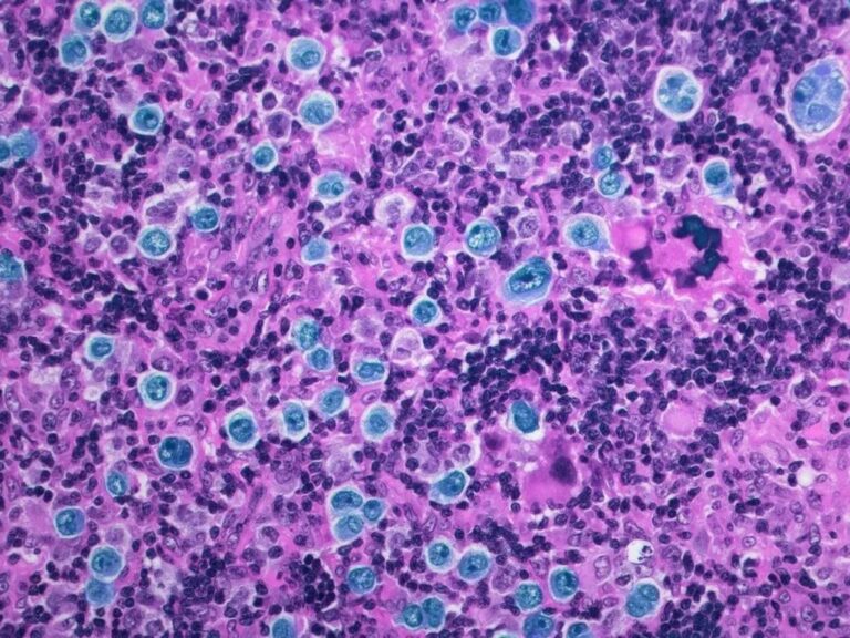 Médicos israelíes alcanzan un avance revolucionario en el tratamiento del cáncer