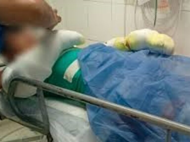 Adolescente sufre quemaduras en el 60% del cuerpo tras explosión de su celular