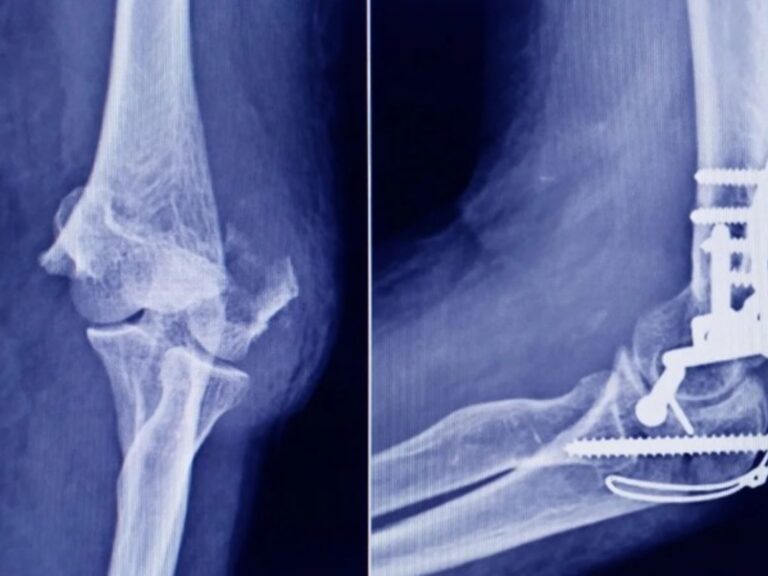 ANMAT alerta sobre tornillos falsificados en cirugías traumatológicas