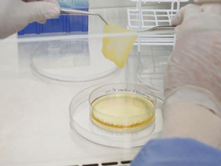 Recupera su piel tras sufrir quemaduras en el 60% del cuerpo gracias a una innovadora técnica nacional