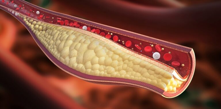 Nuevas Guías: Valores de Colesterol para Prevenir Infartos y ACV