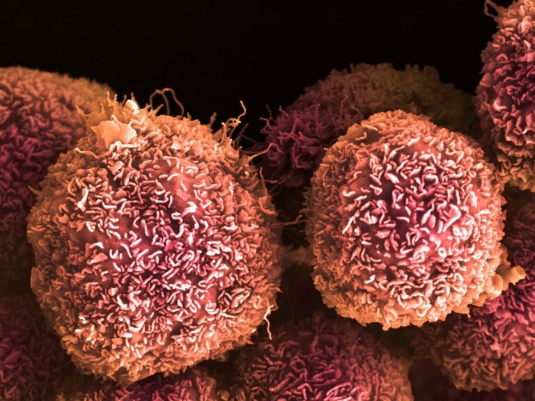 De lo Imposible a la Esperanza: Un Avance Revolucionario en la Lucha contra el Cáncer de Páncreas