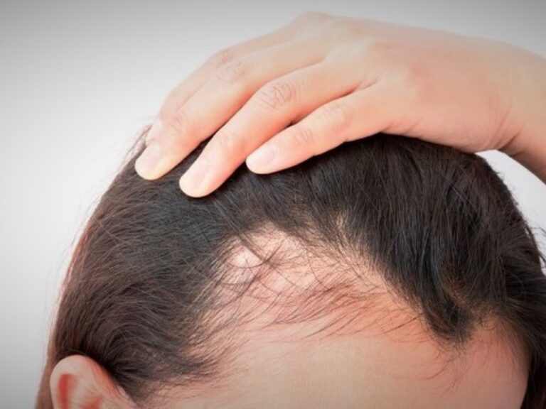 Descubren una nueva causa de la pérdida de cabello por tratamientos médicos en auge.